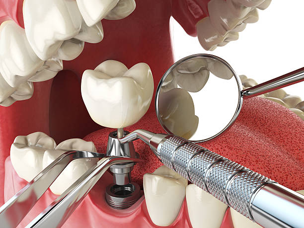 Best Emergency Broken Tooth Repair in Hayden, CO